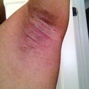 7 days later - left arm