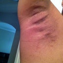 7 days later - right arm
