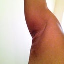 7 days later - right arm, side profile. still see swollen pillowy affect