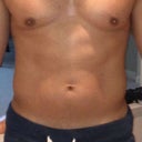 7 days later - torso/waist getting back to normal
