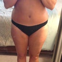 2 days post flank lipo