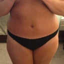 2 days post flank lipo