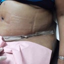 side view 9 days post op