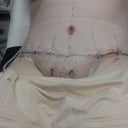 Day one - post op