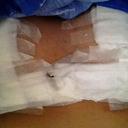Post Op Day 1 to 3 looked like this