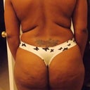 8 days before my surgery