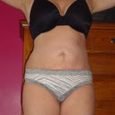 12 WEEKS POST OP
