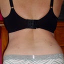 12 WEEKS POST OP