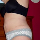 12 WEEKS POST OP