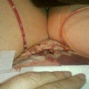 Here is what I looked like on May 1st 5 days PO