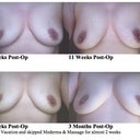 Weeks 10, 11, and 12 Post-Op.  Plus 3 month explant anniversary.