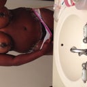 Here you can see how low my incision line is. It is well below my low-cut underwear-Day 8
