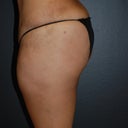 35 Year Old Mom Wnating More Fullness Of Her Buttocks.