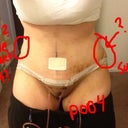 Please help! Is this just swelling? I would hate to get more Lipo..My PS said he will fix it if it's not just swelling.