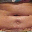5weeks PO-no improvement but getting worst!