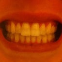 Bite, without aligners, halfway through