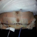 sorry about pubes but it shows the sutures well