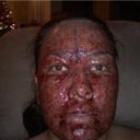 Day 1 / 6 hours post op