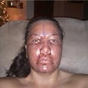 Day 1 / 11 hours post op