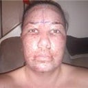 Day 2 / 24 hours post op