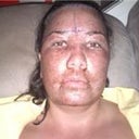 Day 2 / 27 hours post op