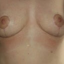 11 weeks post-op
