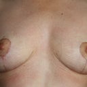 12 weeks post-op