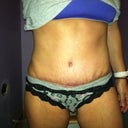 4 weeks 5 days.  The incision is now almost flat.. still have a little bit of puckering above incision due to swelling.. Maderma is helping with the scar a ton!