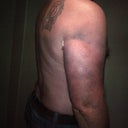 1 day after Vaser Hi-Def to my arms