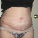 3 Weeks PO scar.  Very low and thin.  I am happy with it thus far.