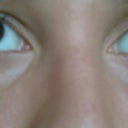 2 weeks after second treatment