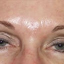 Blepharoplasty And Corrigator Muscle Resection