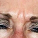 Blepharoplasty And Corrigator Muscle Resection