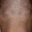 Otoplasty (Ear Surgery)