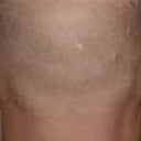 Otoplasty (Ear Surgery)