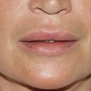 Lip Augmentation
