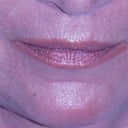 Lip Augmentation