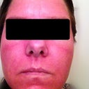 Treatment 4 Day 1