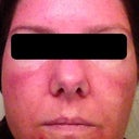 Day 2 Second Treatment