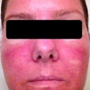 Day 3 Second Treatment