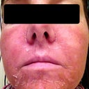 Day 4 Second Treatment