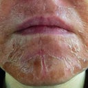 Day 5 treatment 2