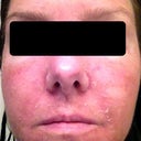 Day 5 Treatment 2 After Shower