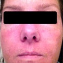 Day 6 Treatment 2