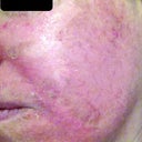 Day 6 treatment 2