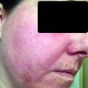 Day 6 Treatment 2