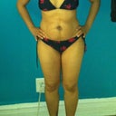 Me before surgery in a bikini I hope to be able to wear and look better in post op! Excuse the bruising by my belly button that is from my tubal ligation.