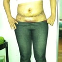 5 days post op