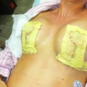 One day post op!