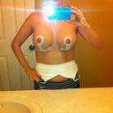 6 days post op